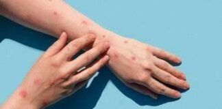 Monkeypox: किस उम्र के लोगों को है मंकीपॉक्स से ज्यादा खतरा ?, जानें इसके लक्षण और बचाव के सही तरीके