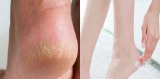 फटी एड़ियों से छुटकारा पाने के लिए अपंनाए ये आसान घरेलू नुस्खे Crackheels
