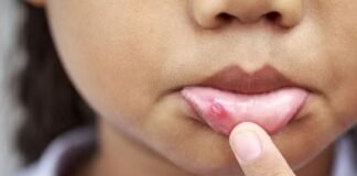 मुंह में बार-बार हो रहे छाले?अनदेखा न करें, हो सकती हैं खतरनाक समस्याएं
