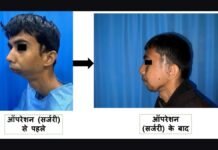 UP: AIIMS गोरखपुर में जटिल ऑर्थोग्नाथिक सर्जरी से 22 वर्षीय युवक को दी नई जिंदगी
