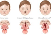 कटे होंठ और तालु (Cleft Lip & Palate): समय पर इलाज से बच्चों की मुस्कान, बोलने की क्षमता और आत्मविश्वास लौट सकता है