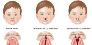 कटे होंठ और तालु (Cleft Lip & Palate): समय पर इलाज से बच्चों की मुस्कान, बोलने की क्षमता और आत्मविश्वास लौट सकता है