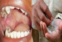 उत्तराखंड में हर साल 12 हजार लोग मुंह और गले के कैंसर की चपेट में, 36% महिलाएं भी शामिल